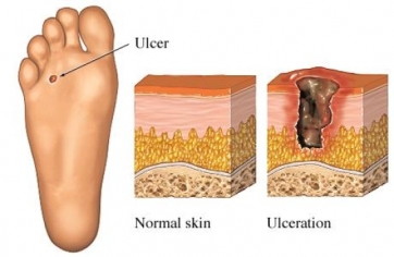 Diabetic Wound Care