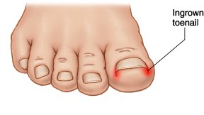 Ingrown Toenails Services Quakertown, PA