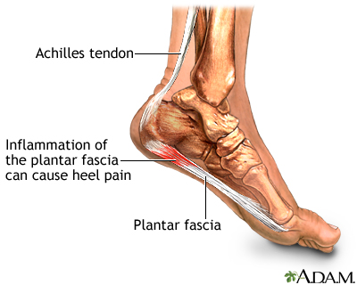 Plantar Fascitis Quakertown