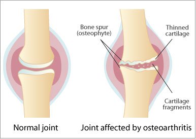 Osteoarthritis Services Quakertown, PA